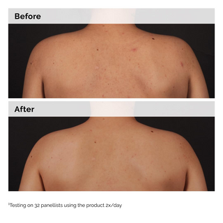 Before and after comparison of a person's back with visible skin conditions.