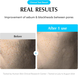 before and after results of sebum and blackheads improvement