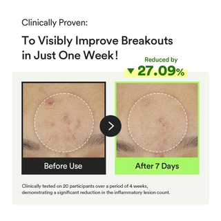 before and after comparision of skin with improved breakouts