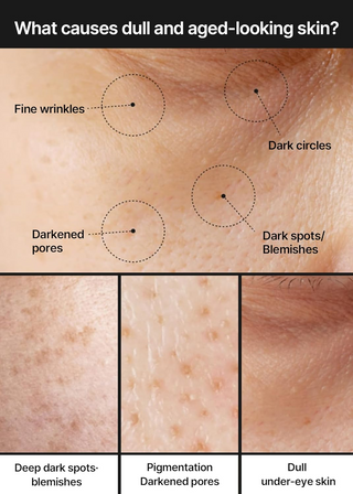 dull and aged looking skin with pigmentation, blemishes and wrinkles