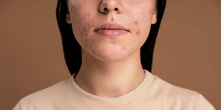 Acne Scars vs. Hyperpigmentation: How to Tell and Treat Them