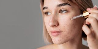 How to Use Niacinamide for Acne and Skin Texture