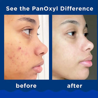 PanOxyl Acne Foaming Wash 10  Benzoyl Peroxide Maximum Strength before and after differences